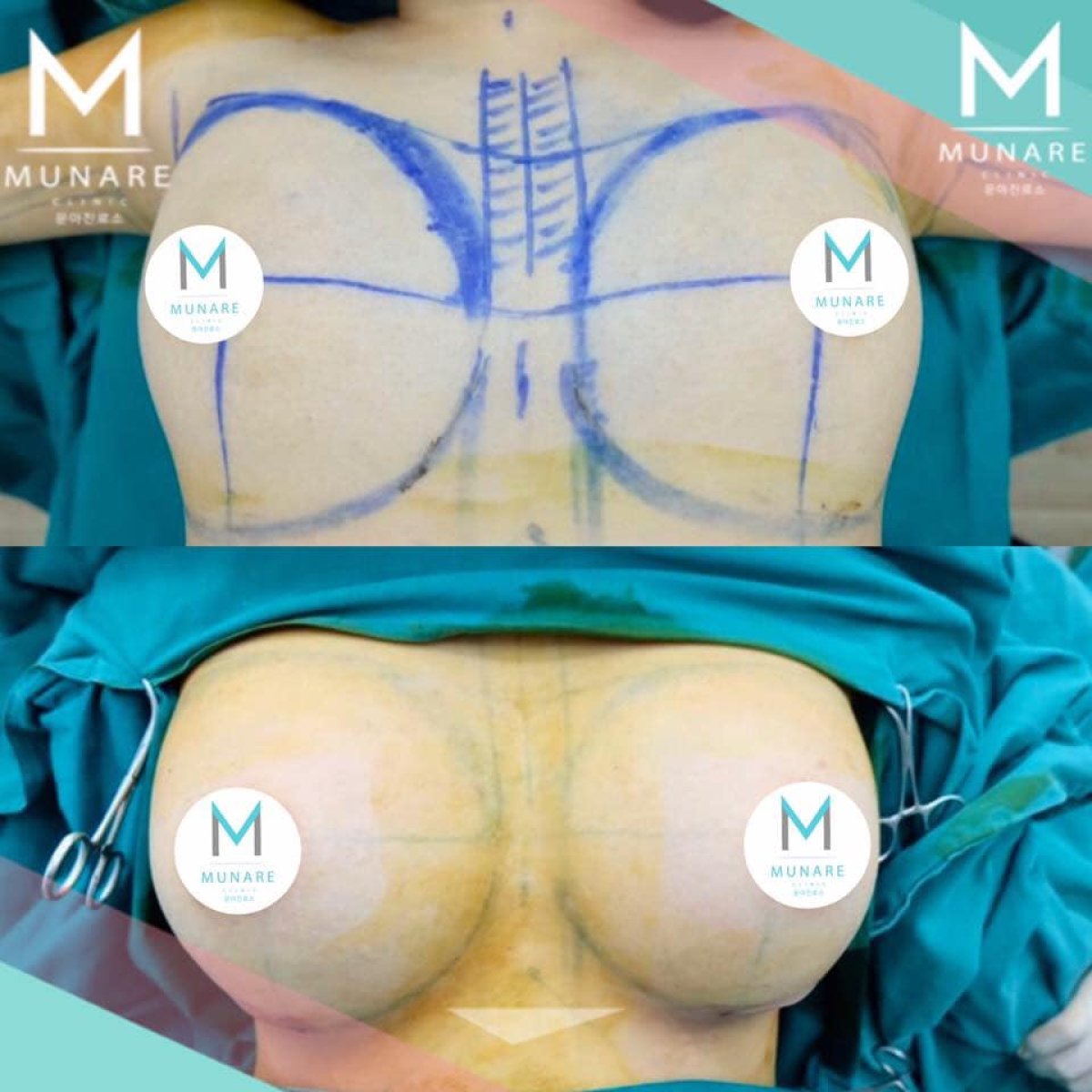 Antes y después de aumento de senos en Munare Clinic – resultado de mayor volumen mamario