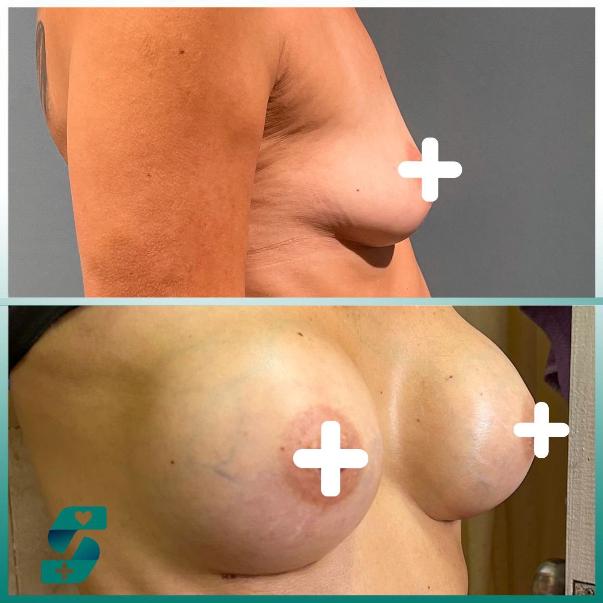 Resultados de mamoplastia antes y después en Soraca Med – mayor forma y volumen mamario