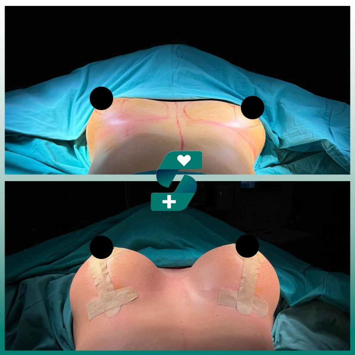 Resultados de mamoplastia antes y después en Soraca Med – aumento visible de senos