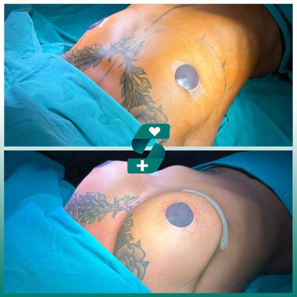 Resultados de mamoplastia antes y después en Soraca Med – aumento visible de senos