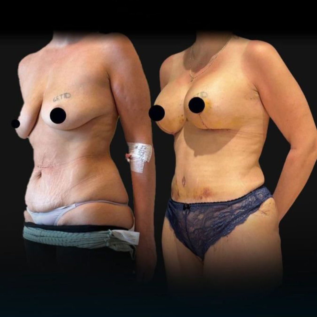 Resultados de mamoplastia antes y después en Soraca Med – mejora de pecho y contorno corporal