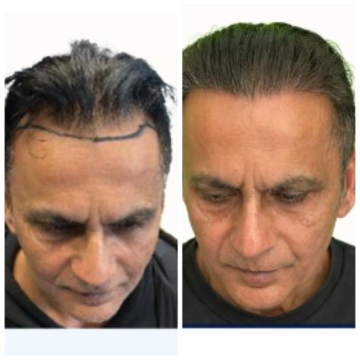 نتائج زراعة الشعر قبل وبعد في Alpha Beauty Hannover، خط شعر محسّن للمريض