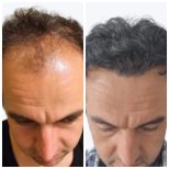 DHI hair transplantation results by Dr. bilal Elbey - Patient’s before and after images Before and after DHI hair transplantation photos by Dr. bilal Elbey