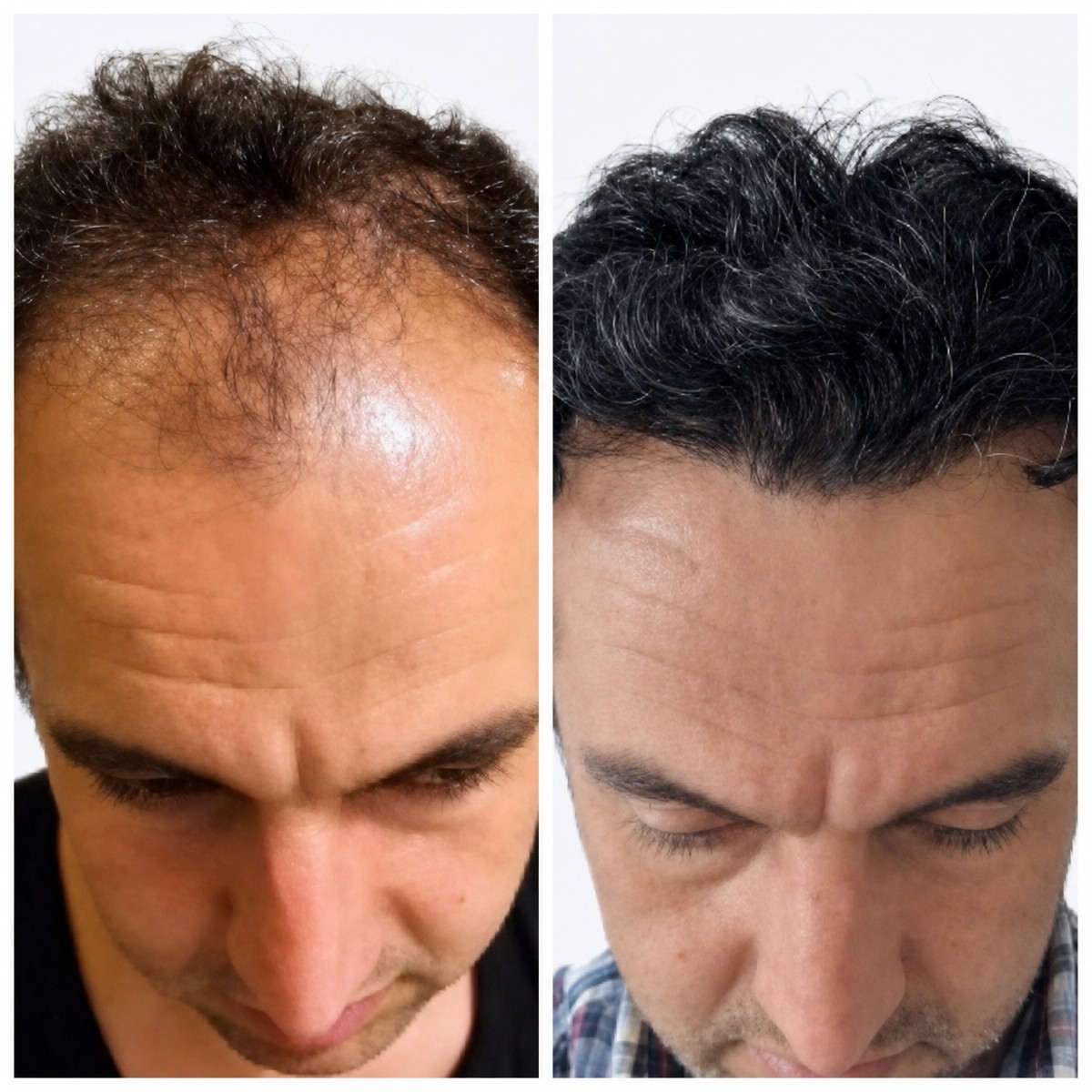 Before and after PRP hair loss treatment results at Alpha Beauty Hannover, improved hair density
