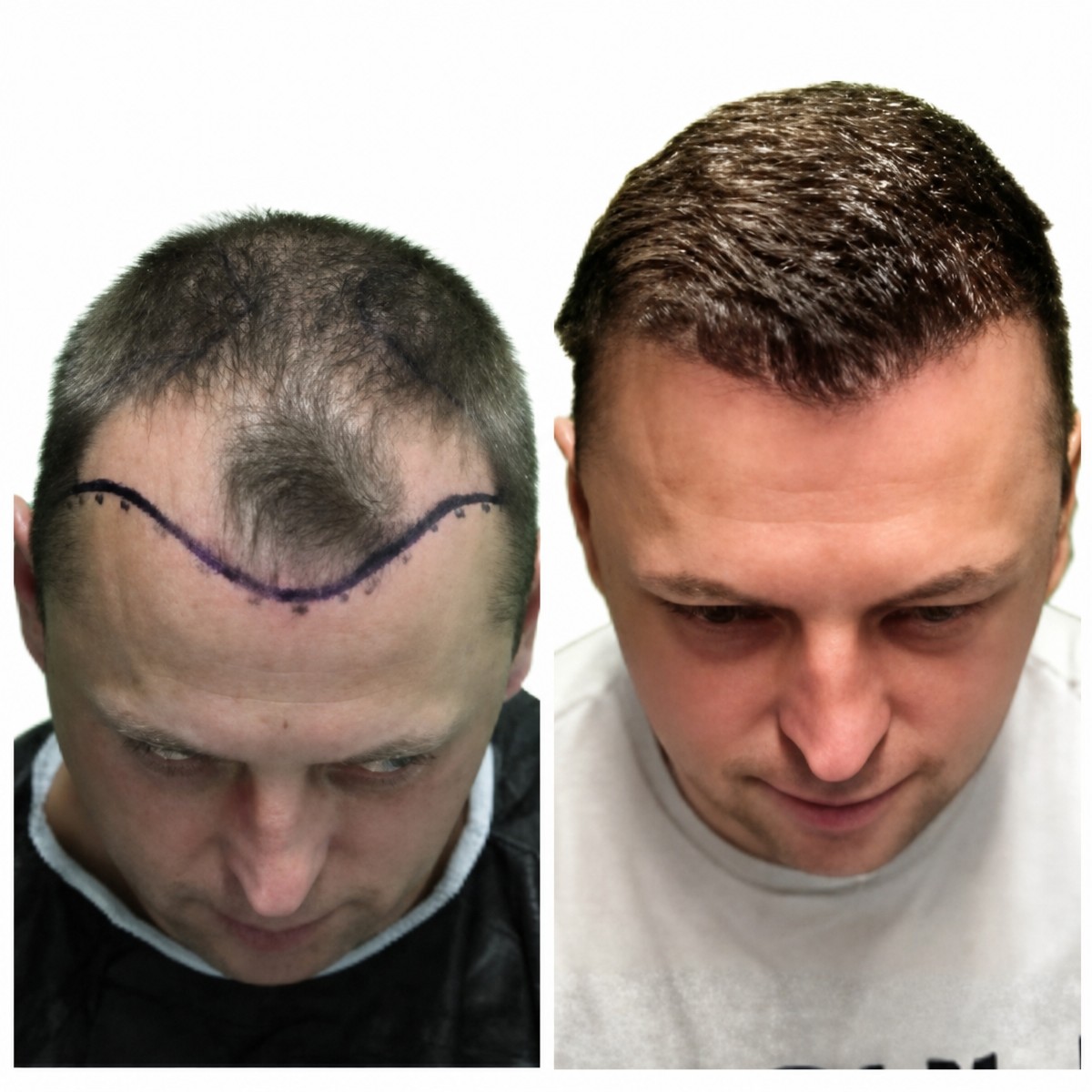 نتائج زراعة الشعر قبل وبعد في Alpha Beauty Hannover، استعادة خط الشعر لدى مريض ذكر
