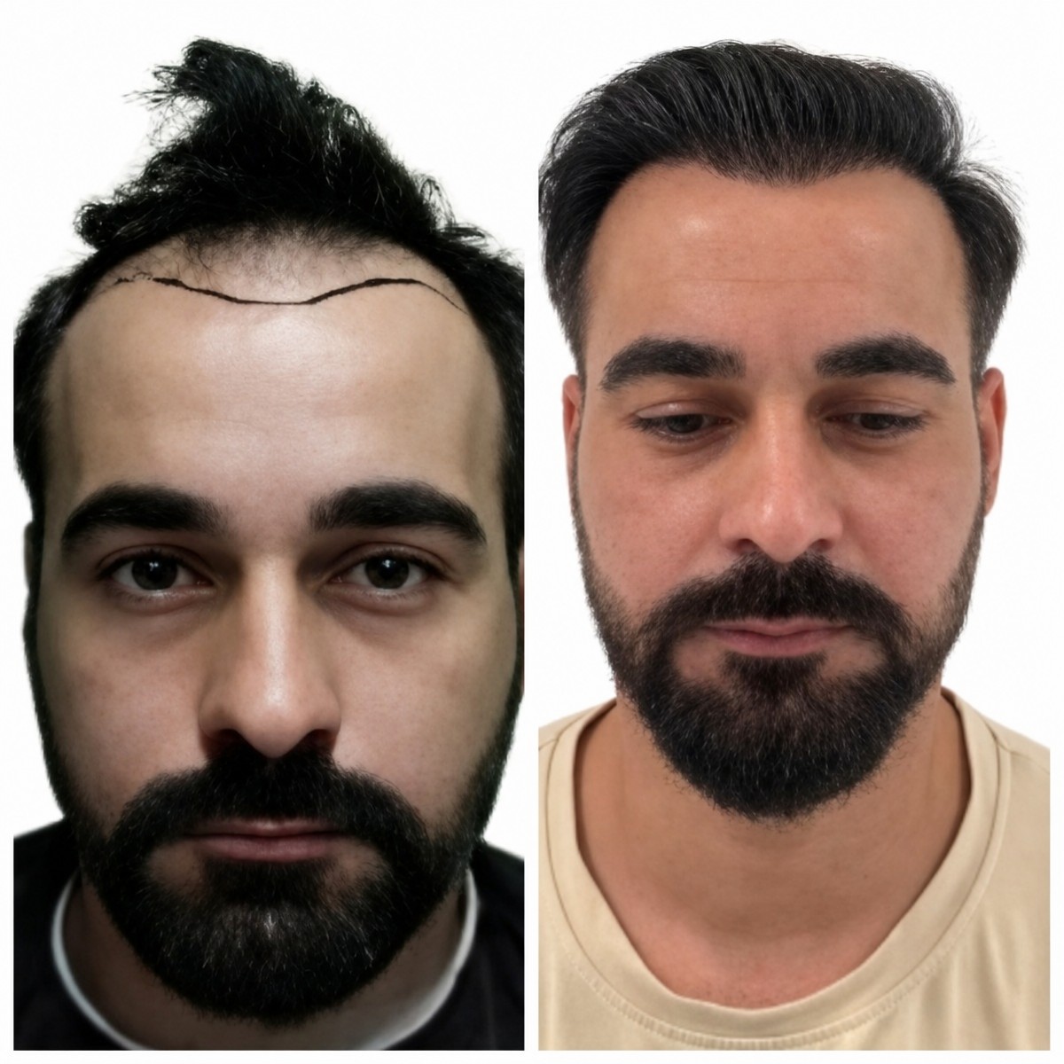 نتائج زراعة الشعر قبل وبعد في Alpha Beauty Hannover – استعادة خط الشعر الممتلئ