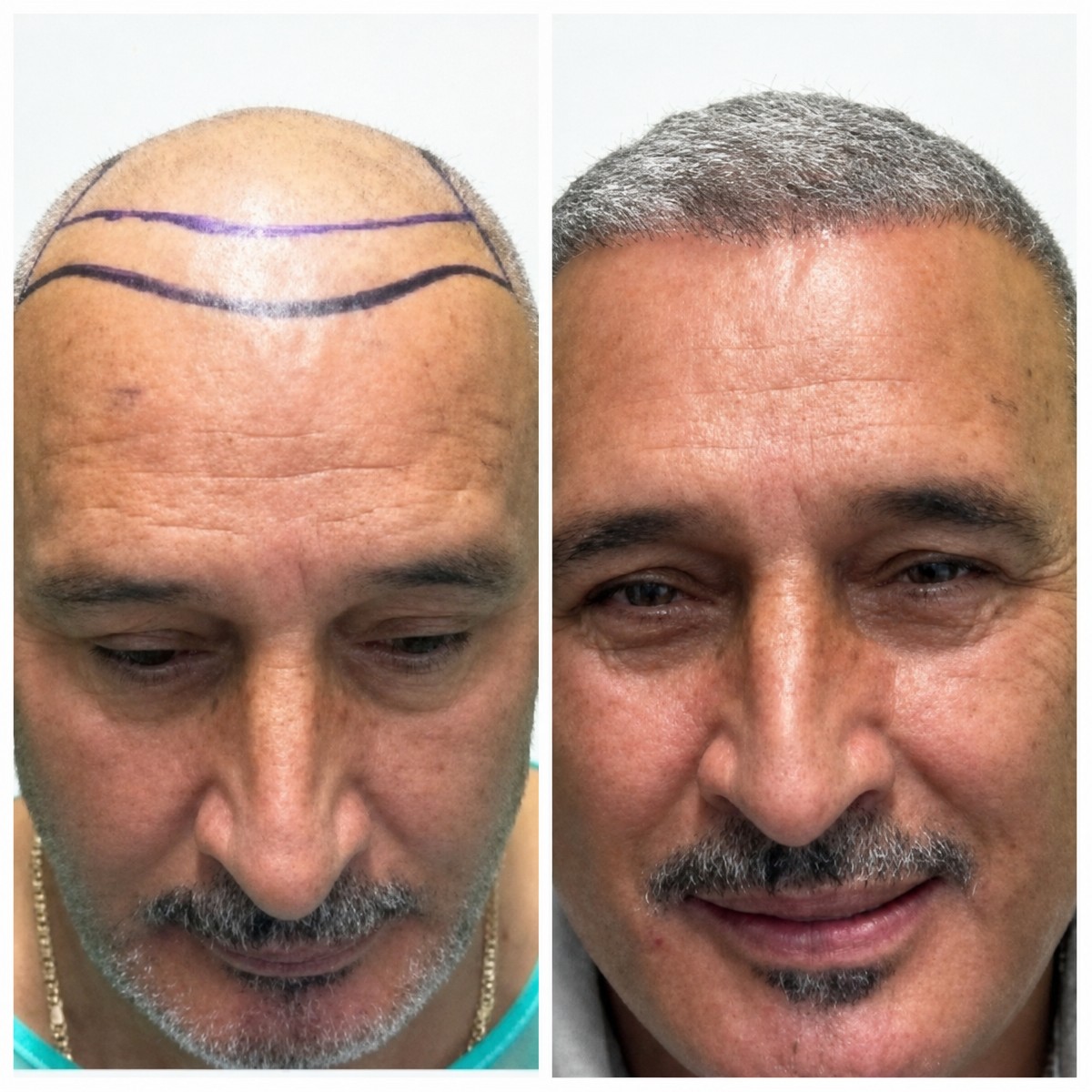 Before and after FUE hair transplant results at Alpha Beauty Hannover, restored hairline in male