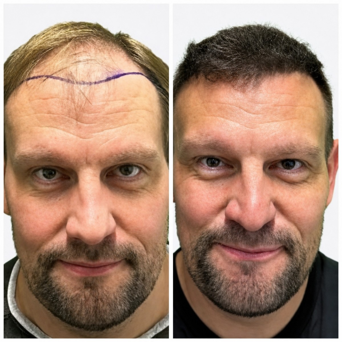 Résultats avant/après greffe de cheveux FUE chez Alpha Beauty Hannover, ligne frontale restaurée