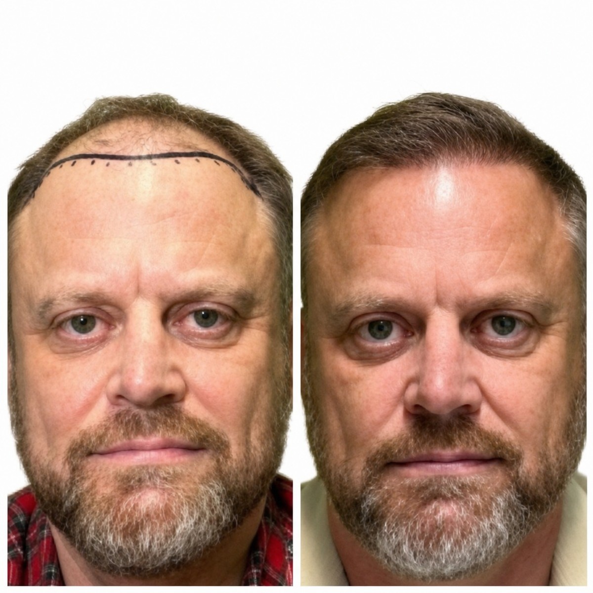 Before and after hair transplant results at Alpha Beauty Hannover, restored natural hairline
