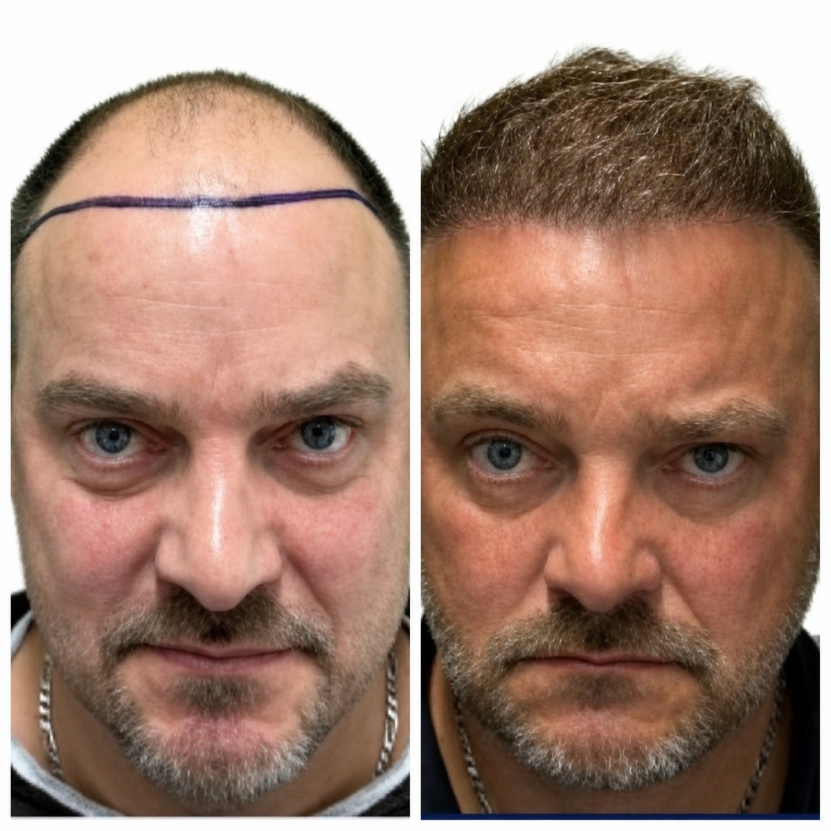 Resultados de trasplante capilar antes y después en Alpha Beauty Hannover, línea restaurada