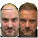 DHI hair transplantation results by Dr. bilal Elbey - Patient’s before and after images Before and after DHI hair transplantation photos by Dr. bilal Elbey