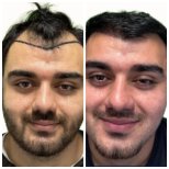 DHI hair transplantation results by Dr. bilal Elbey - Patient’s before and after images Before and after DHI hair transplantation photos by Dr. bilal Elbey