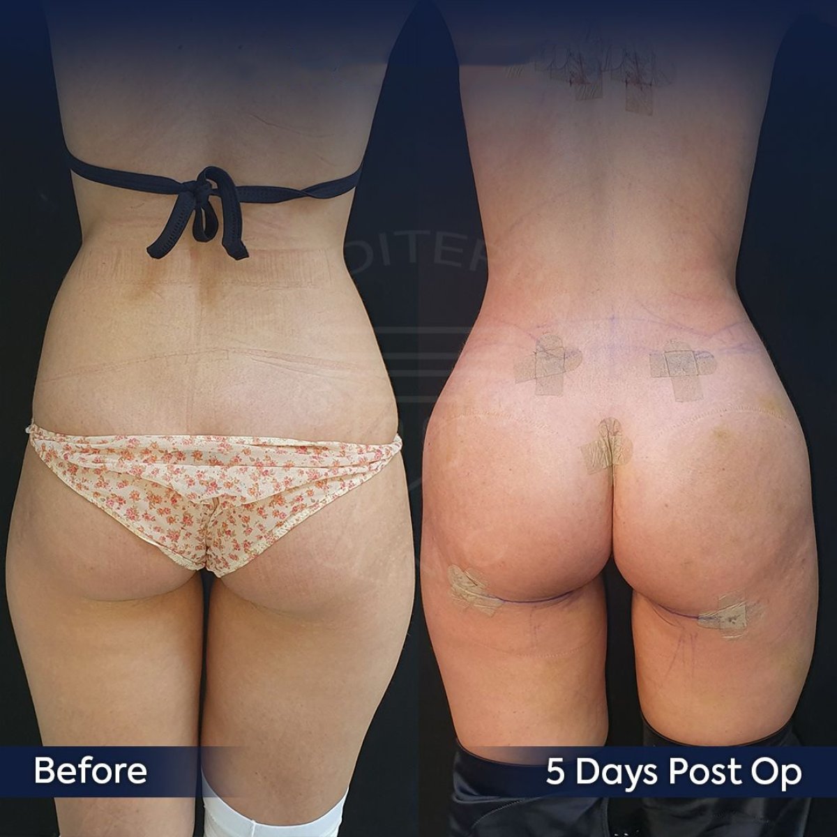 نتائج قبل وبعد عملية Brazilian Butt Lift في عيادة Dr. Safa Manav، تحسين واضح للمنحنيات