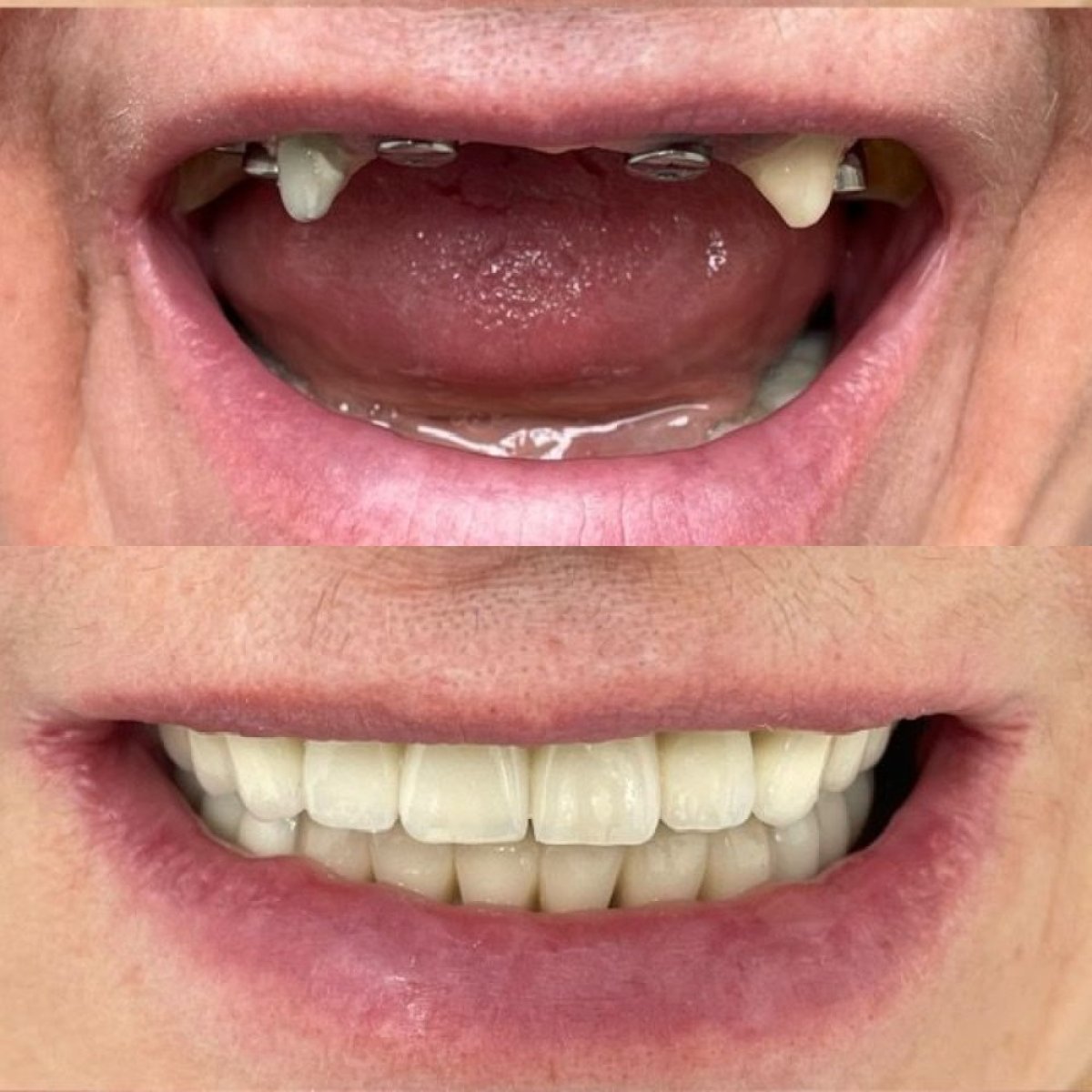 Résultats avant et après la pose de couronnes dentaires à VerMax Dental Clinic, sourire amélioré