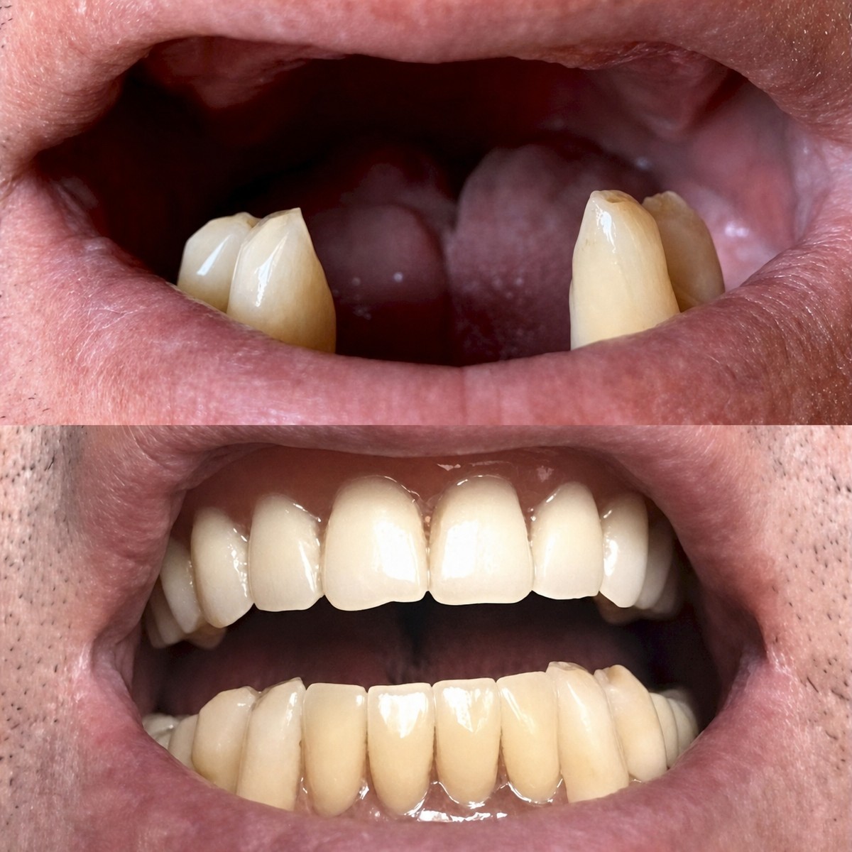 До и после установки зубных коронок в VerMax Dental Clinic, восстановленная улыбка