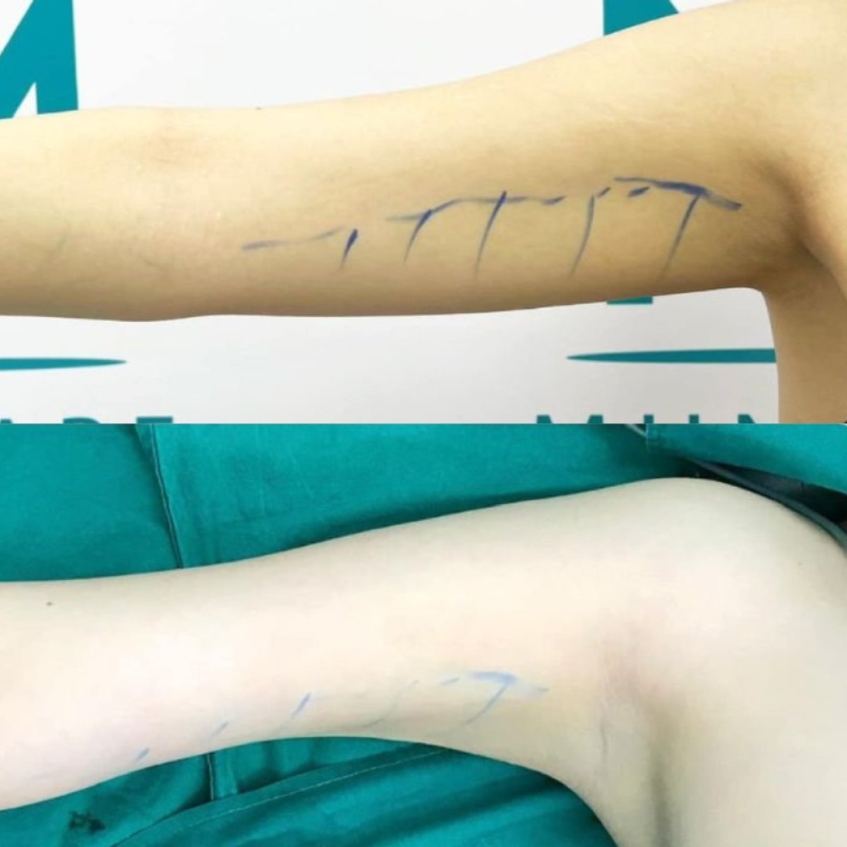 Resultados de liposucción de brazo superior antes y después en Munare Clinic, mejor contorno