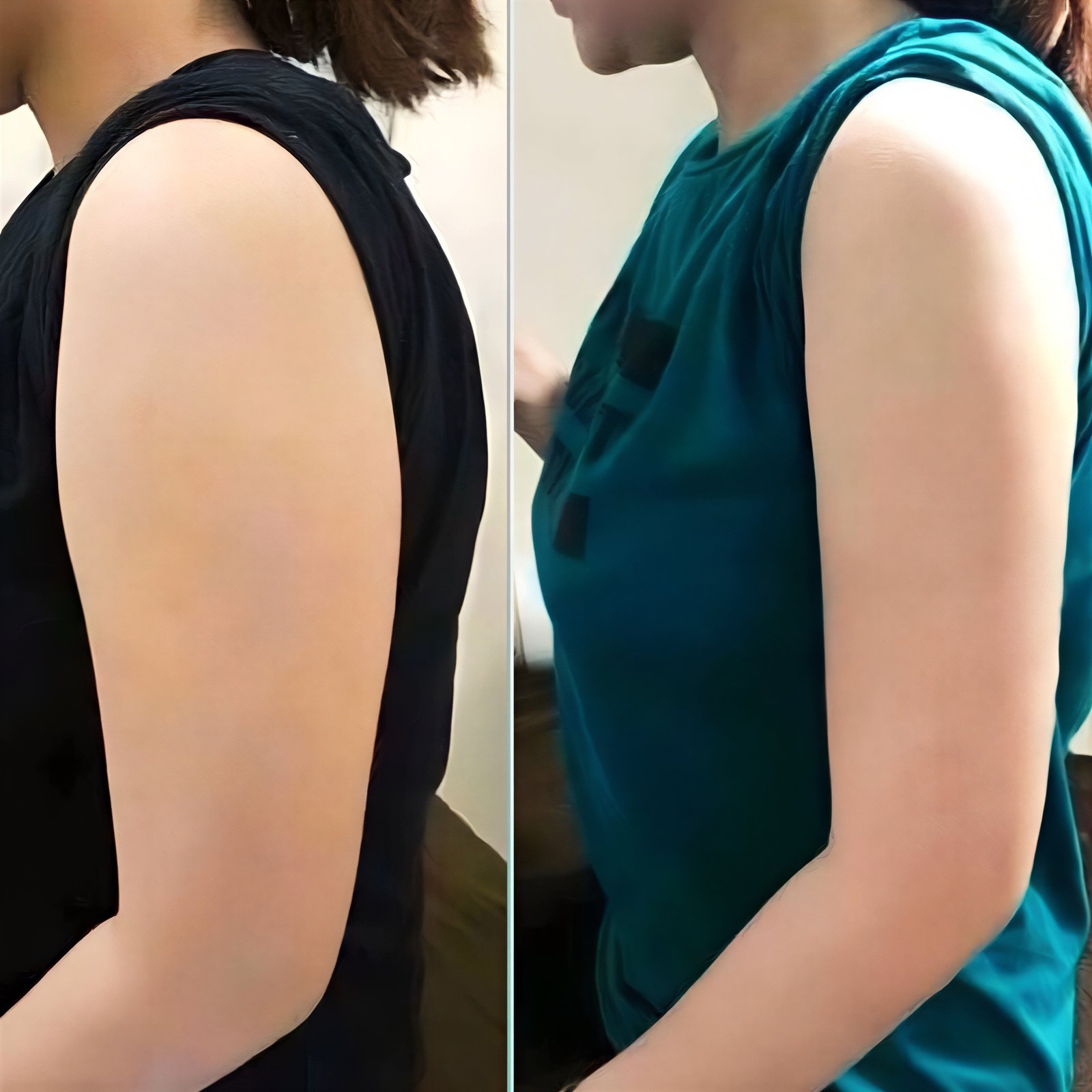 Resultados de liposucción de brazos antes y después en Munare Clinic, mejora del contorno