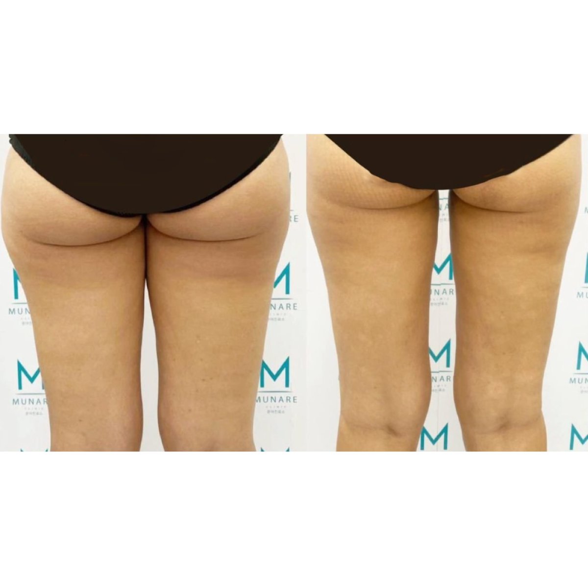 Before and after thigh liposuction results at Munare Clinic, improved leg contour visible