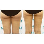 Résultats de la procédure Liposuccion des cuisses par le Dr Tinnakorn Rastiplang - Photos avant et après des patients Photos avant et après par le Dr Tinnakorn Rastiplang