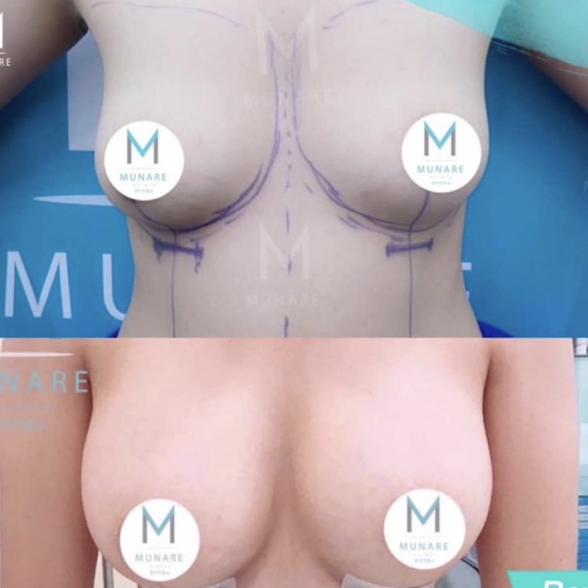 Before and after breast augmentation results at Munare Clinic, enhanced breast volume