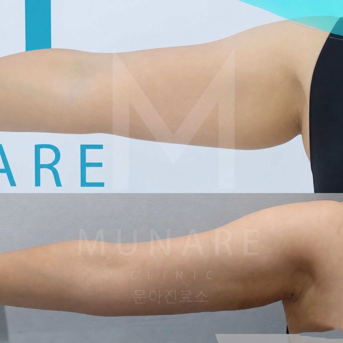Resultados de liposucción de brazo superior antes y después en Munare Clinic, mejor contorno