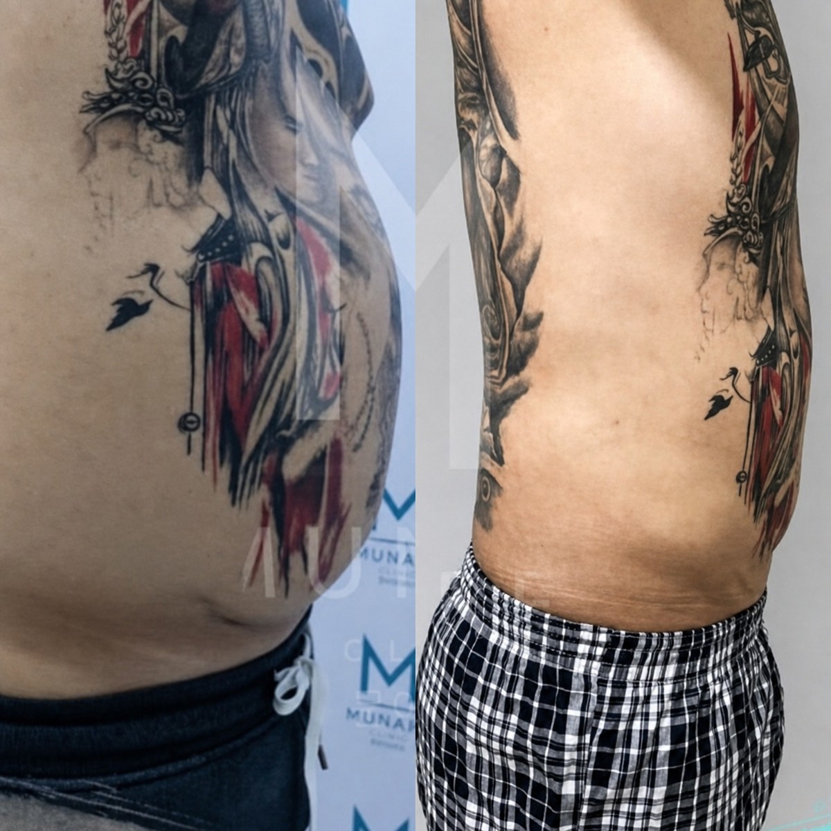 Before and after abdominal liposuction results at Munare Clinic, visible fat reduction