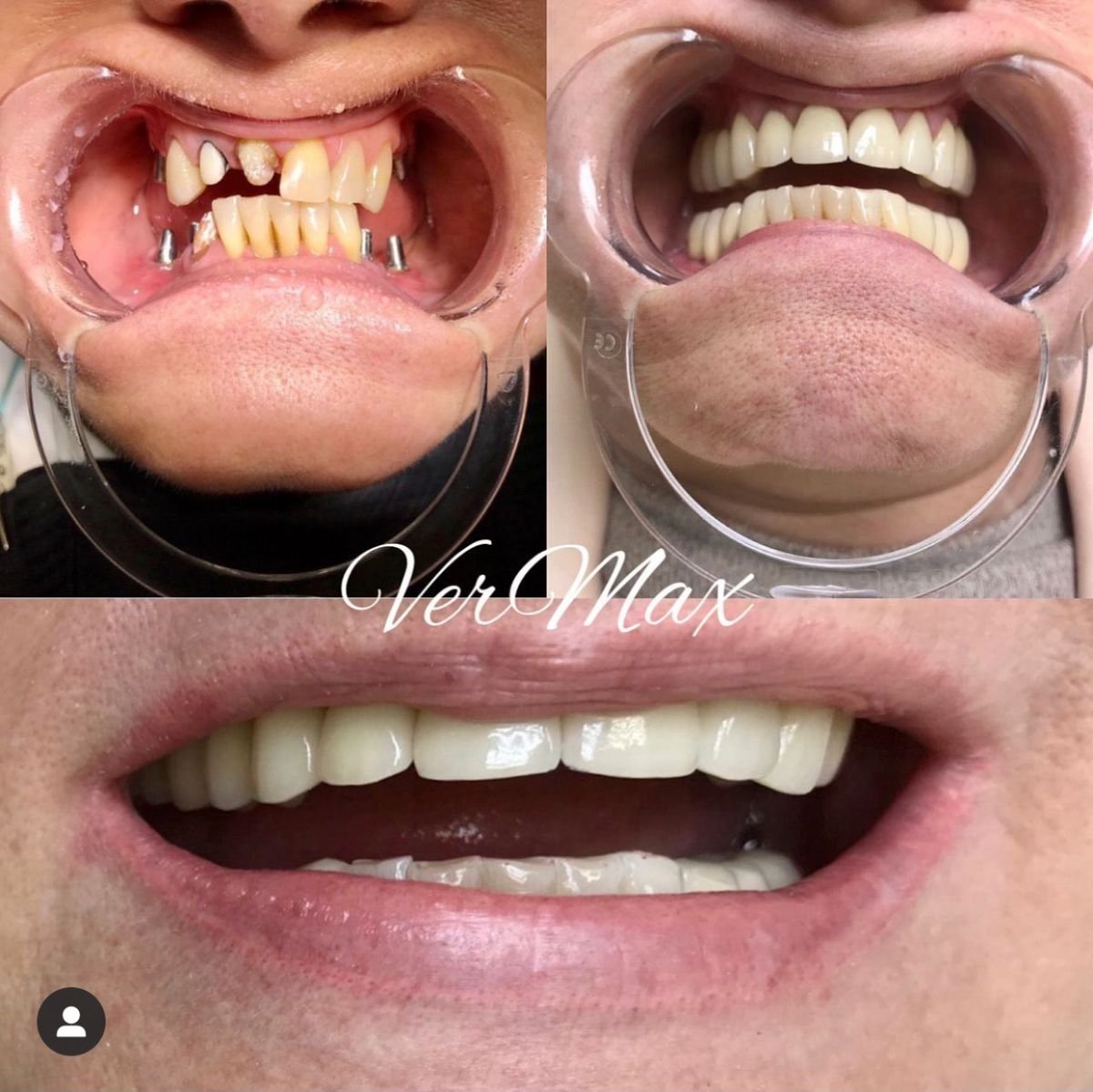 До та після імплантації зубів і Hollywood Smile у VerMax Dental Clinic, помітний результат