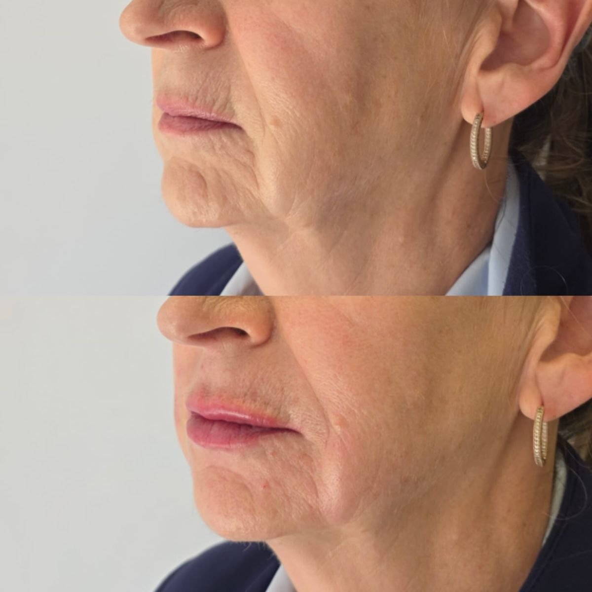 Before and after fillers injection at Dr. Lavalle's Private Practice, facial rejuvenation result