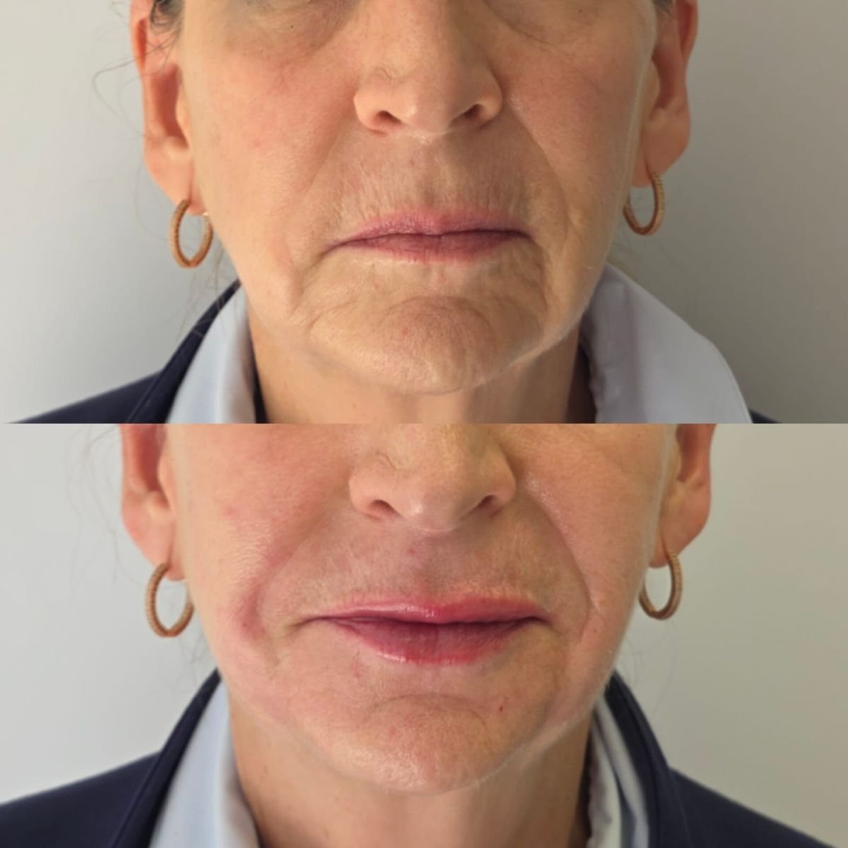 Resultados antes y después de rellenos en Dr. Lavalle's Private Practice, rejuvenecimiento facial