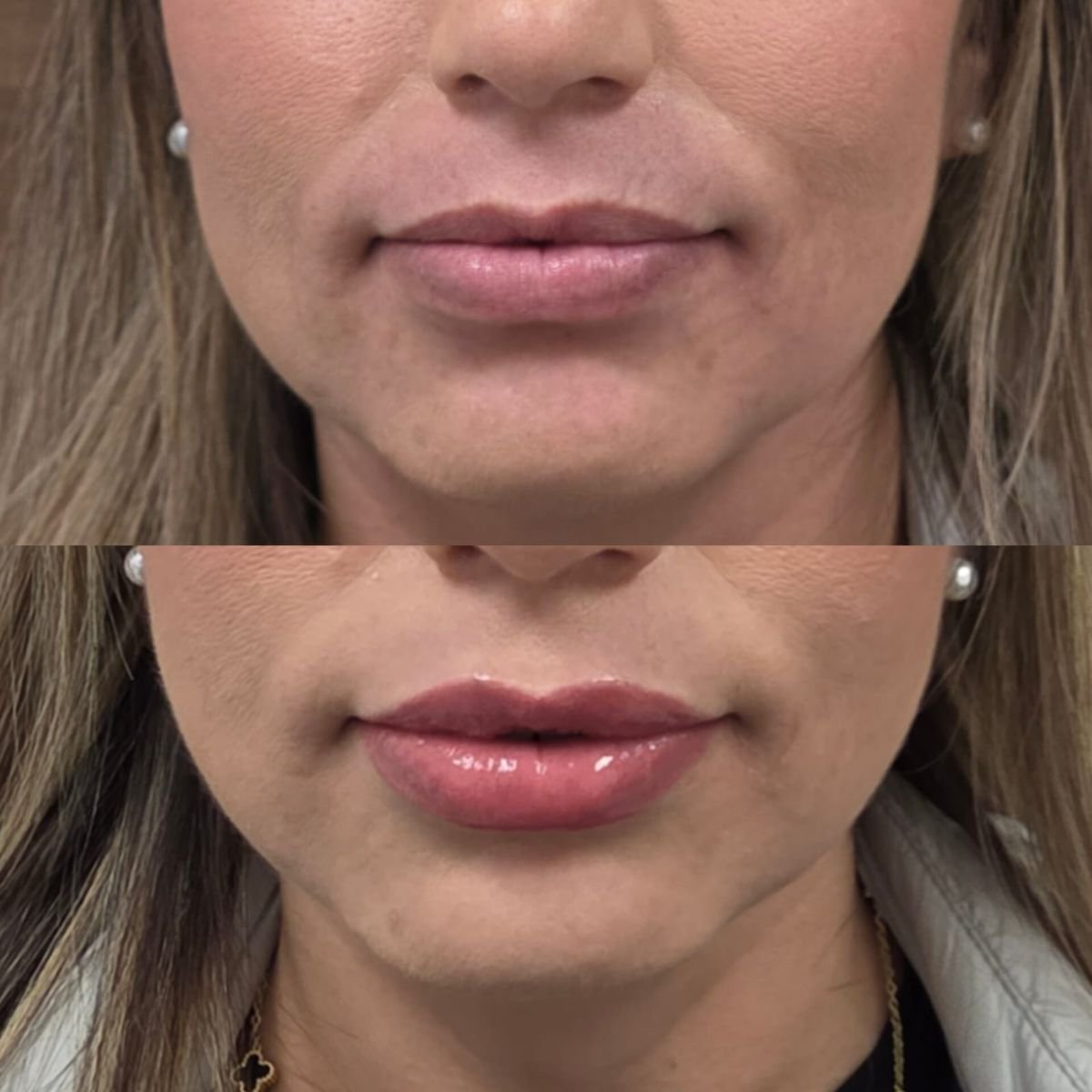 نتائج قبل وبعد حقن فيلر الشفاه في عيادة Dr. Lavalle، زيادة حجم الشفاه