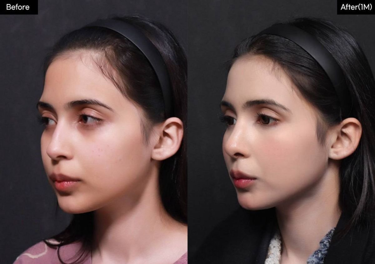 نتيجة قبل وبعد عملية تجميل الأنف المفتوحة في VG Plastic Surgery، تحسين شكل الأنف