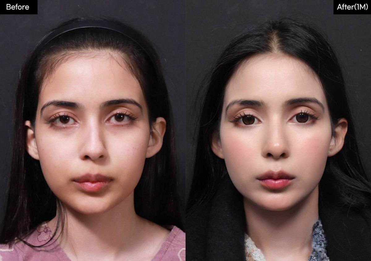 نتيجة قبل وبعد عملية تجميل الأنف المفتوحة في VG Plastic Surgery مع مظهر طبيعي