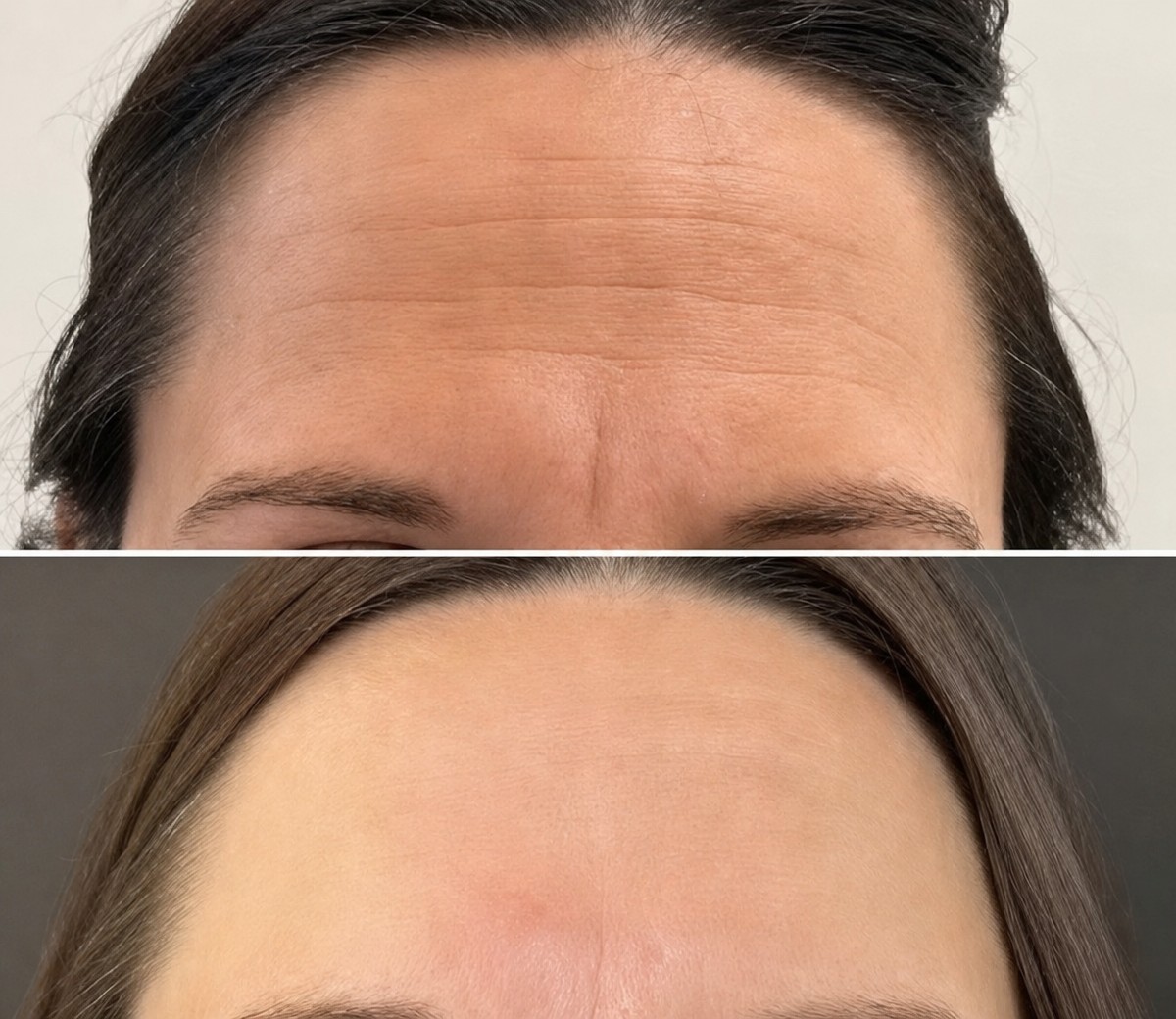 قبل وبعد حقن البوتوكس في Dr. Alexandro Aguilera - Plastic Surgery، جبهة أكثر نعومة