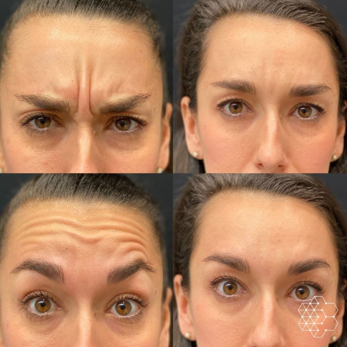 До и после инъекций ботокса в Dr. Alexandro Aguilera - Plastic Surgery, уменьшение морщин лба