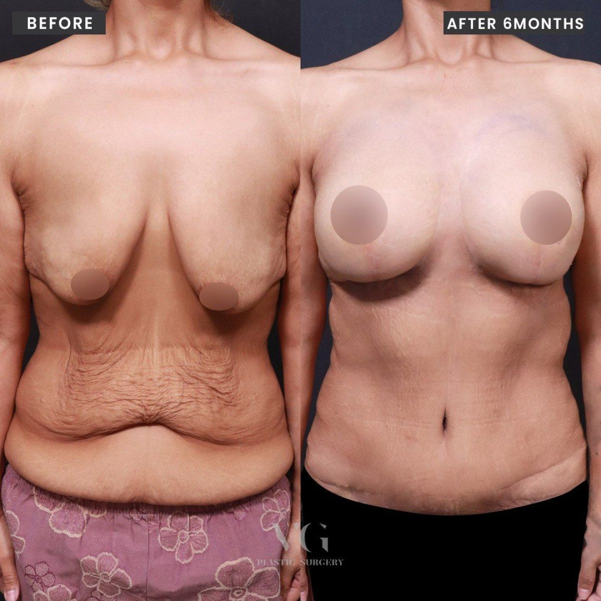 نتائج شفط الدهون وشد البطن قبل وبعد في VG Plastic Surgery، تحسين شكل الجسم