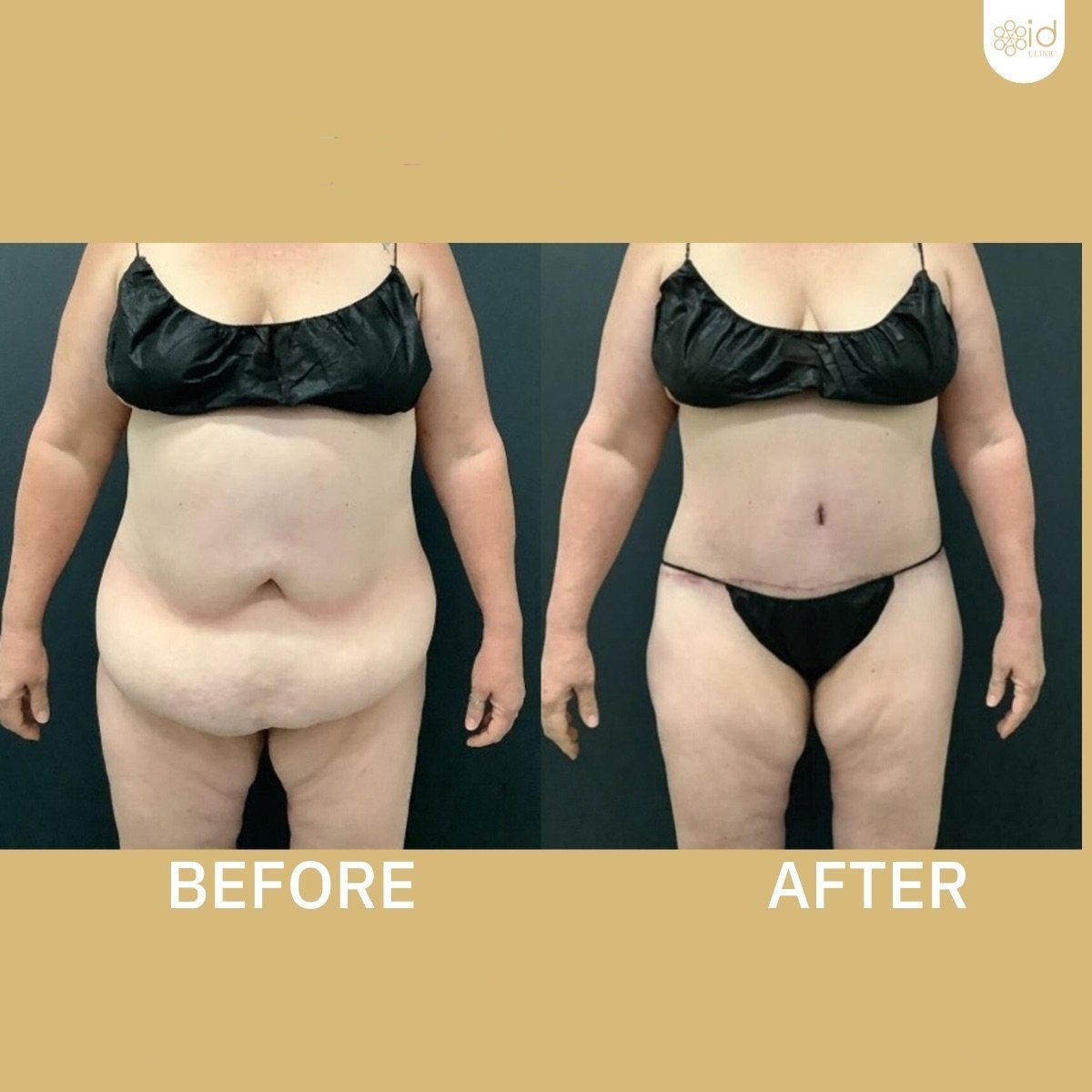 Before and after tummy tuck and liposuction results at ID Clinic Bangkok, flatter abdomen