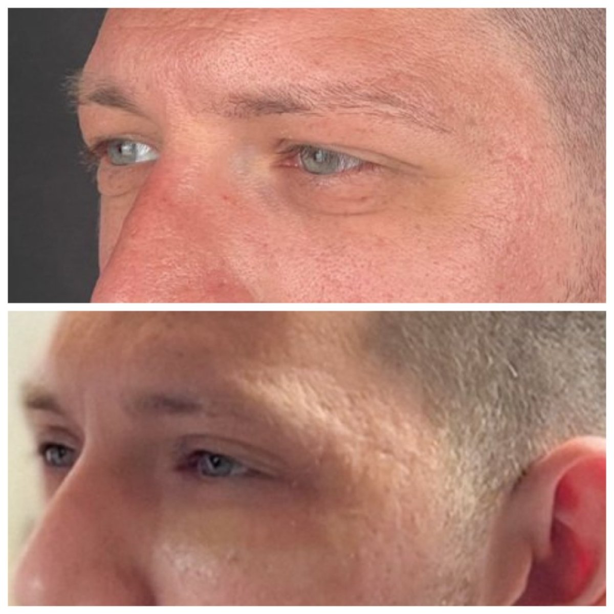 Before and after blepharoplasty results at Soraca Med, improved upper eyelid appearance