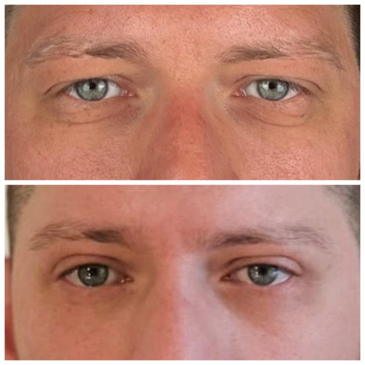 Before and after blepharoplasty results at Soraca Med, eyelid correction for men