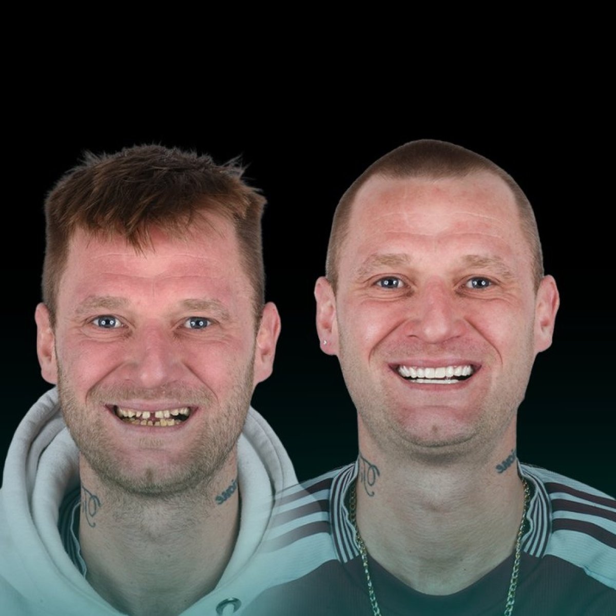 Antes y después de coronas de zirconio en Soraca Med, resultado visible de transformación de sonrisa