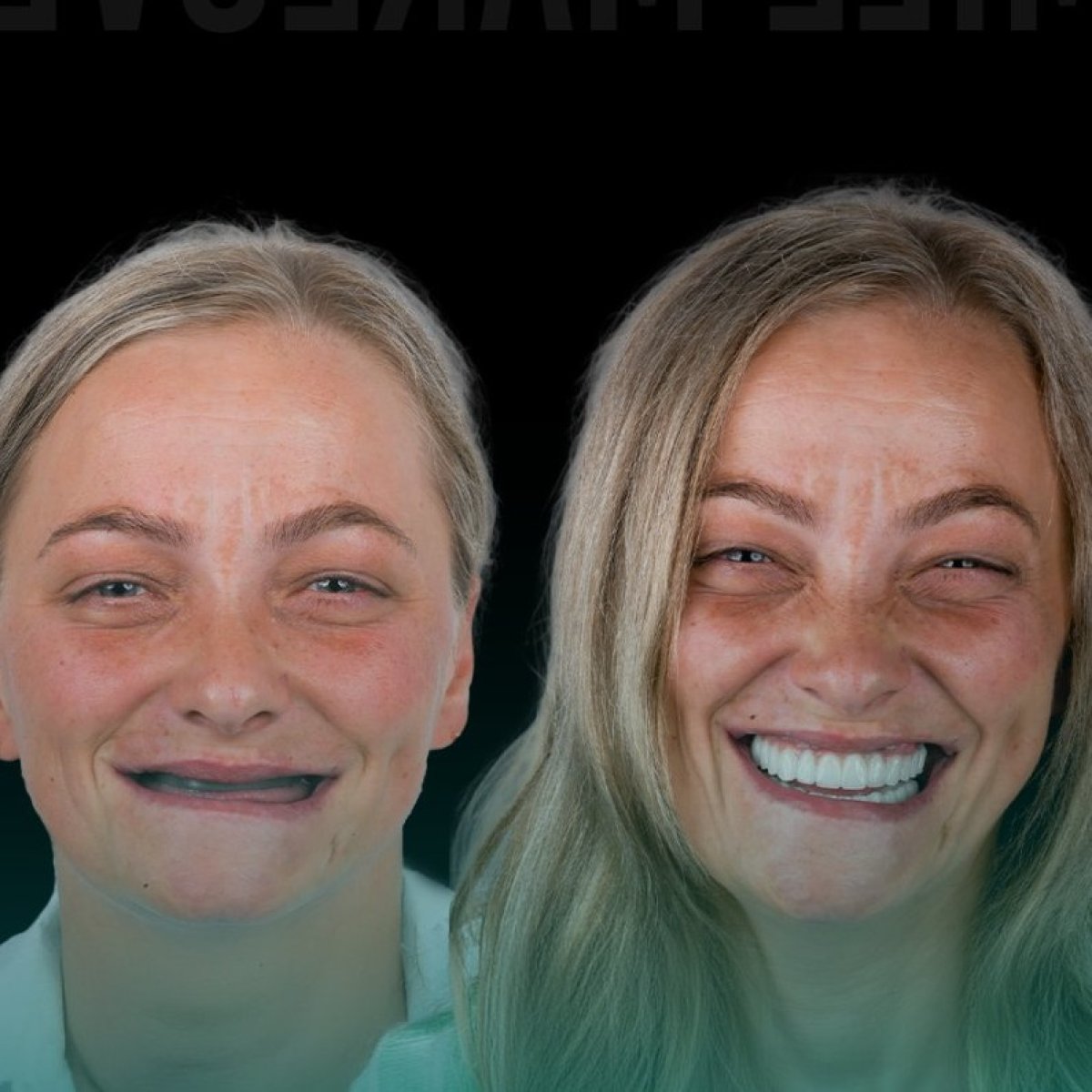 Before and after Zirconia All-on-4 dental implants result at Soraca Med, smile restoration