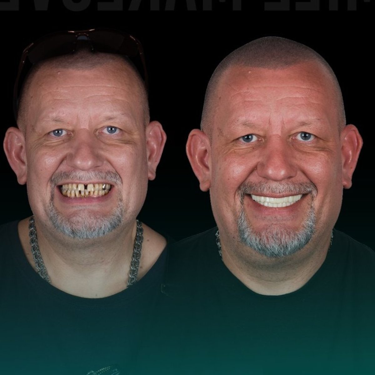 Before and after All-on-6 dental implants result at Soraca Med – full smile restoration