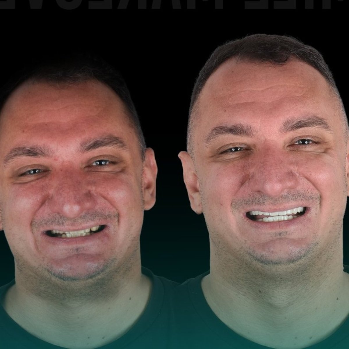 Antes y después de coronas de zirconia en Soraca Med: resultado de sonrisa mejorada
