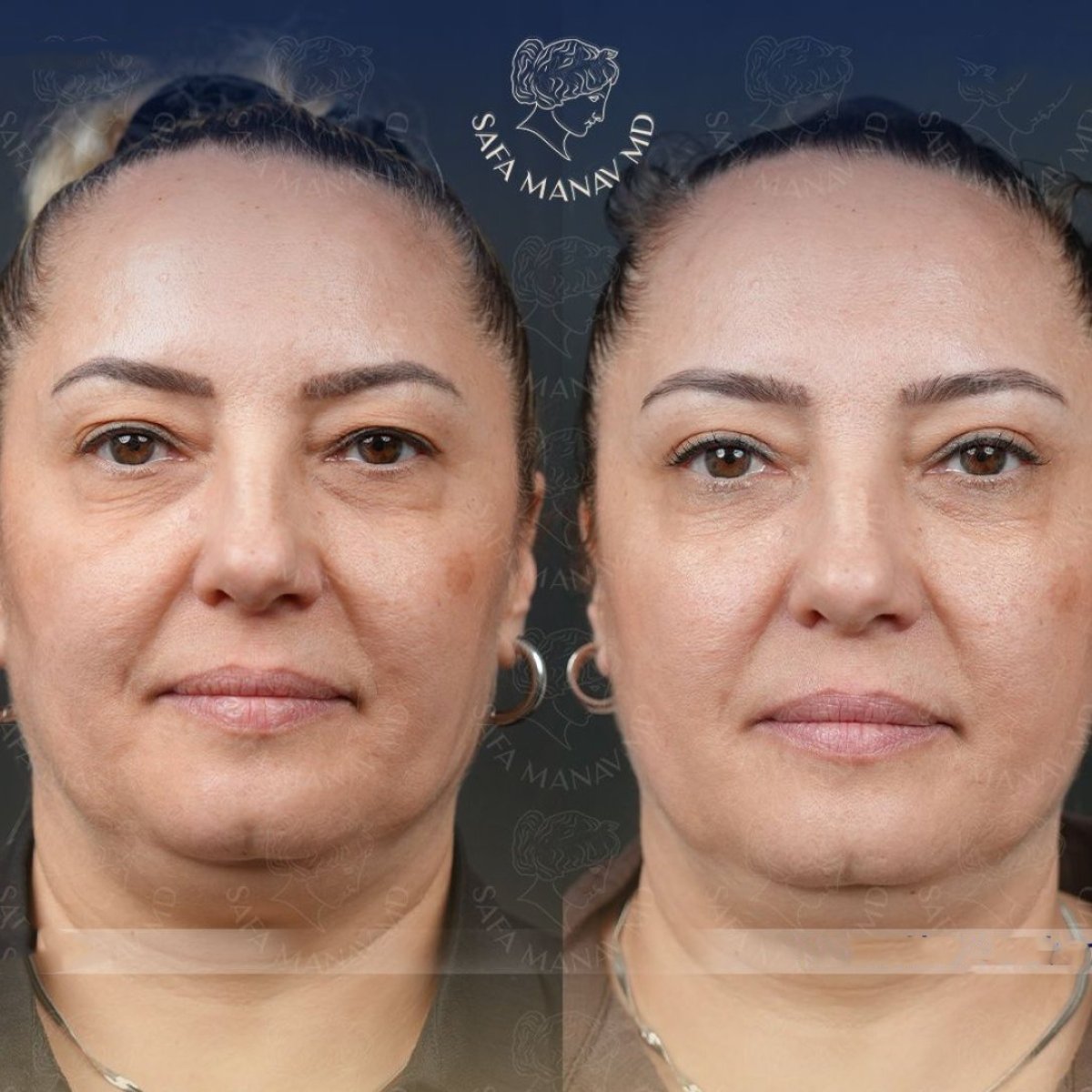 نتائج رأب الجفن قبل وبعد في عيادة Dr. Safa Manav، تحسين الجفون