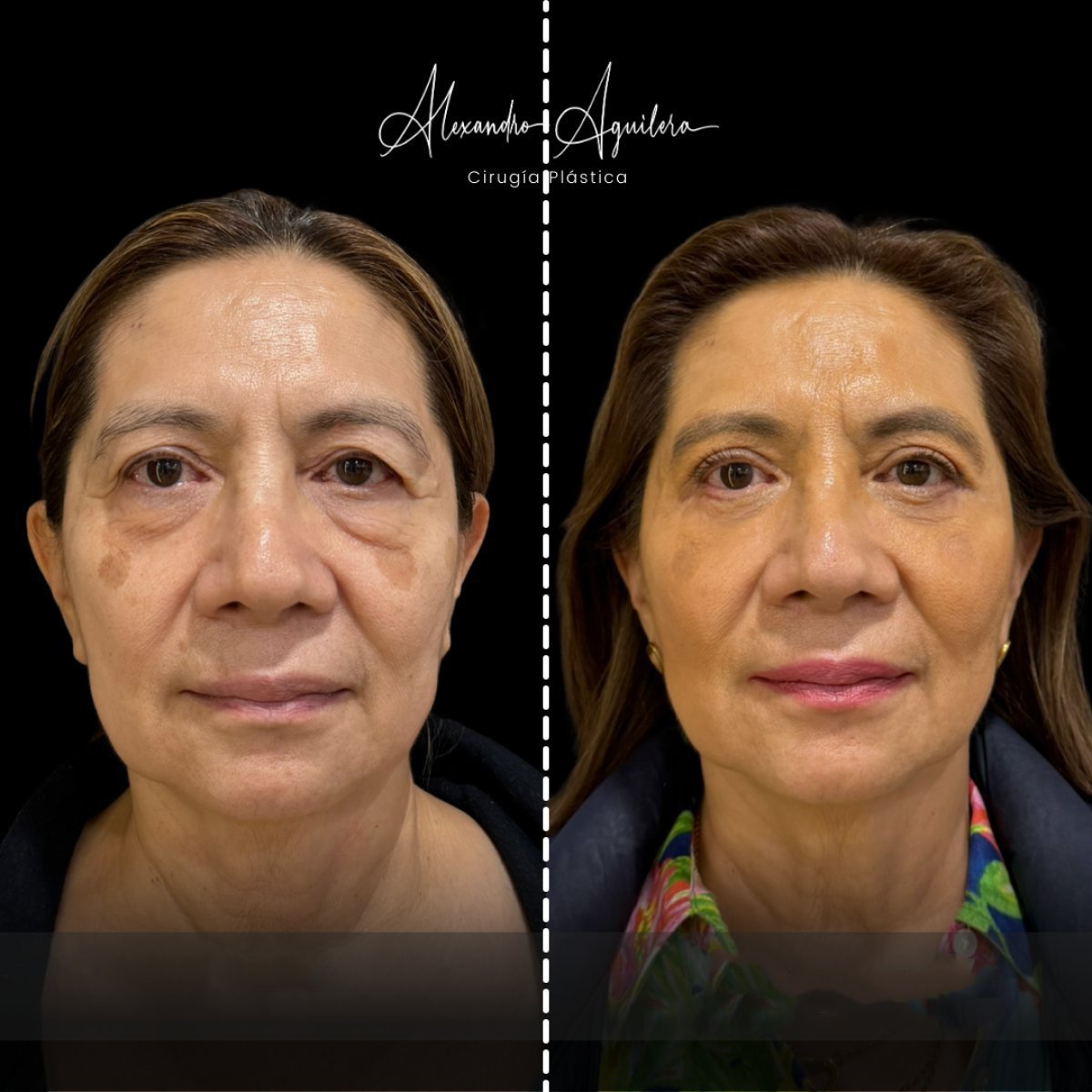 نتائج رأب الجفن السفلي قبل وبعد في عيادة Dr. Alexandro Aguilera للجراحة التجميلية