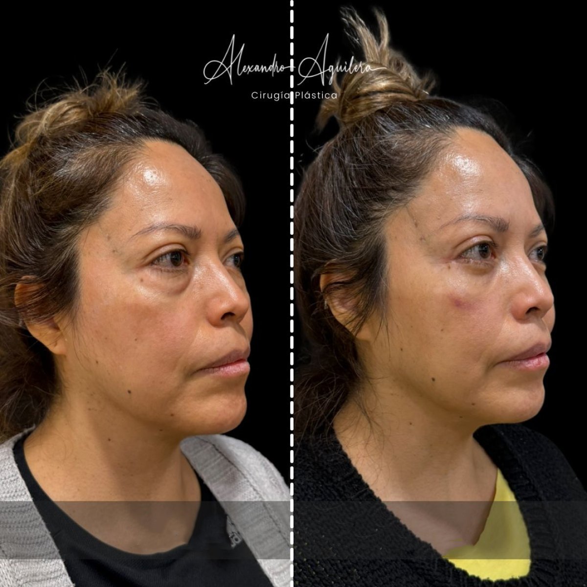Resultados de blefaroplastia de párpado inferior antes y después en Dr. Alexandro Aguilera