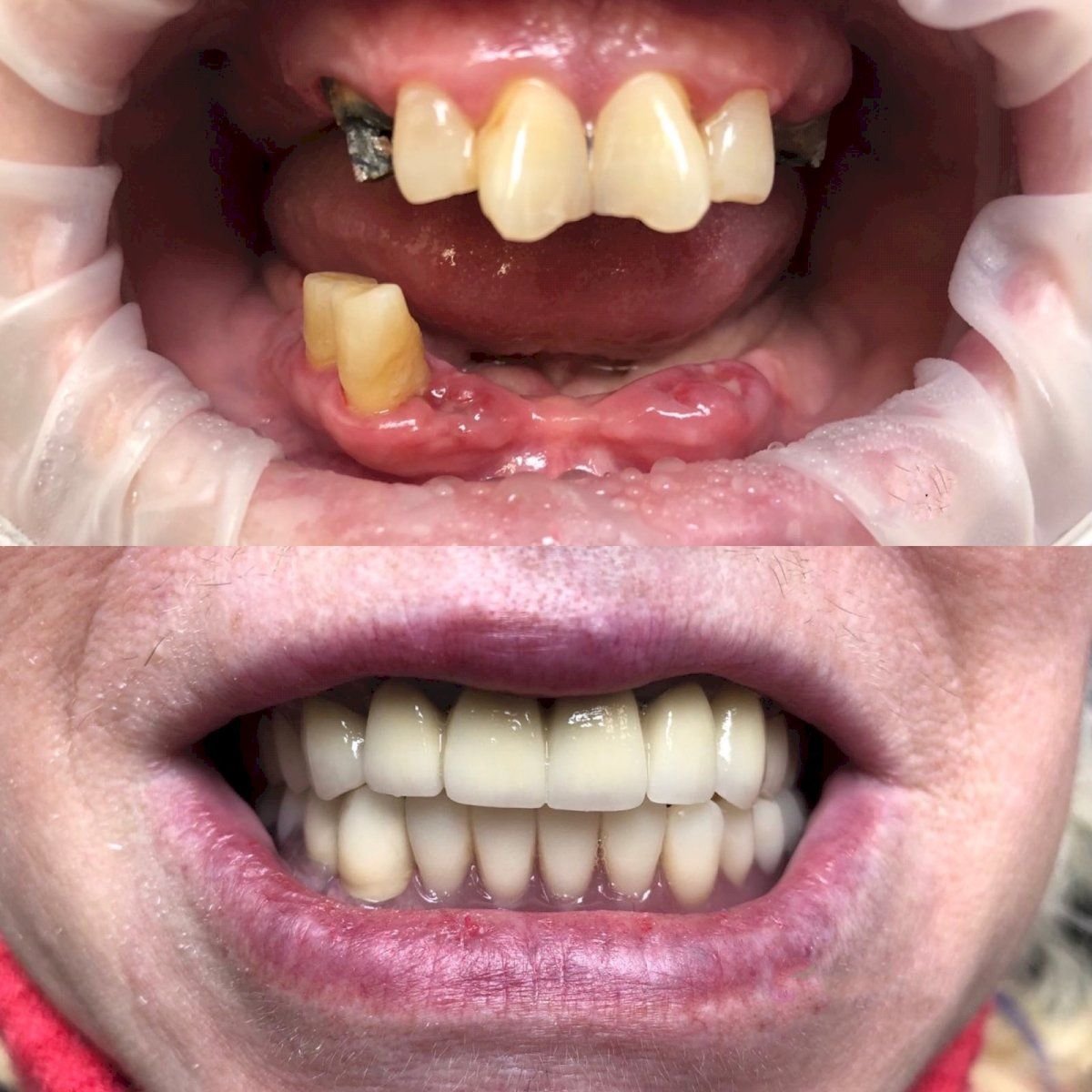 قبل وبعد زراعة الأسنان في VerMax Dental Clinic – نتائج ترميم الفم الكامل