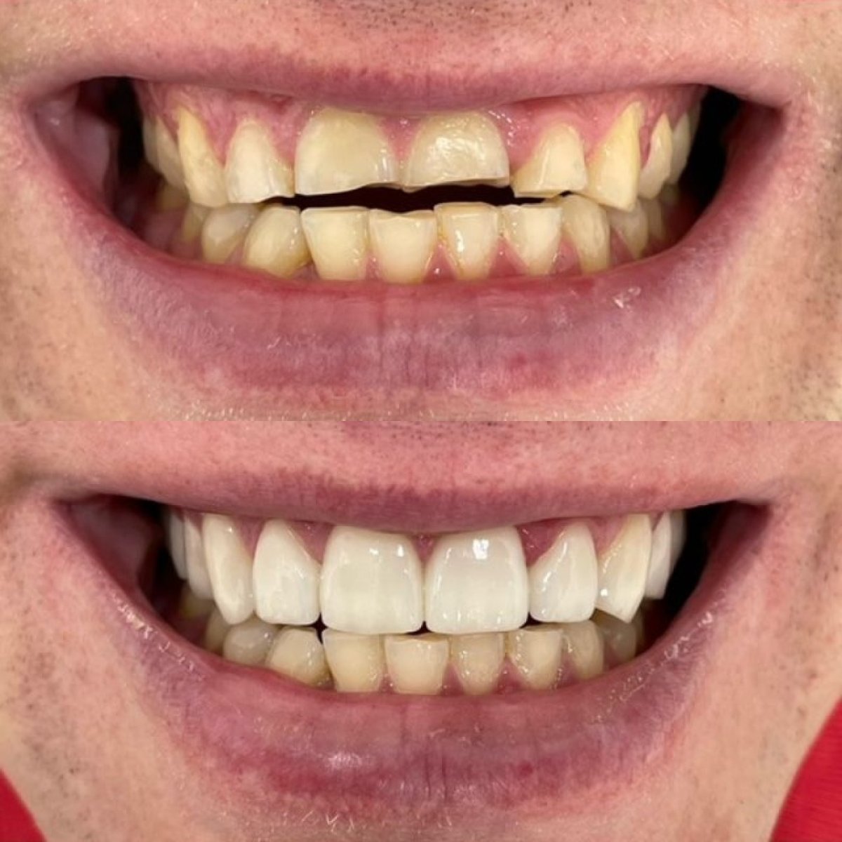 نتائج قبل وبعد ابتسامة هوليوود في VerMax Dental Clinic – تحسين جمالية الأسنان