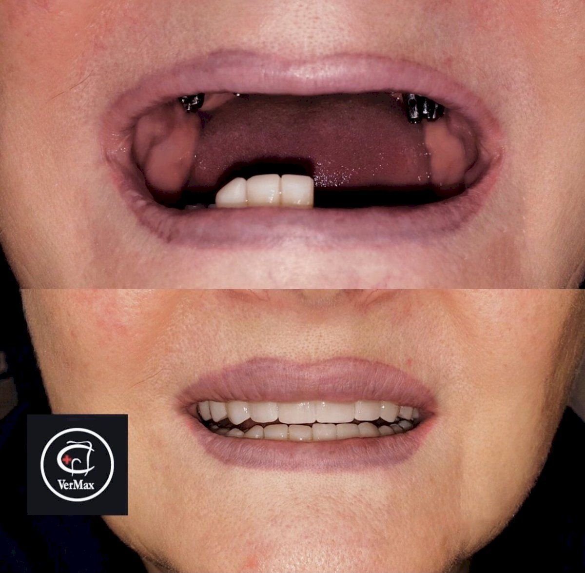 Before and after Straumann dental implants at VerMax Dental Clinic, restored full smile result