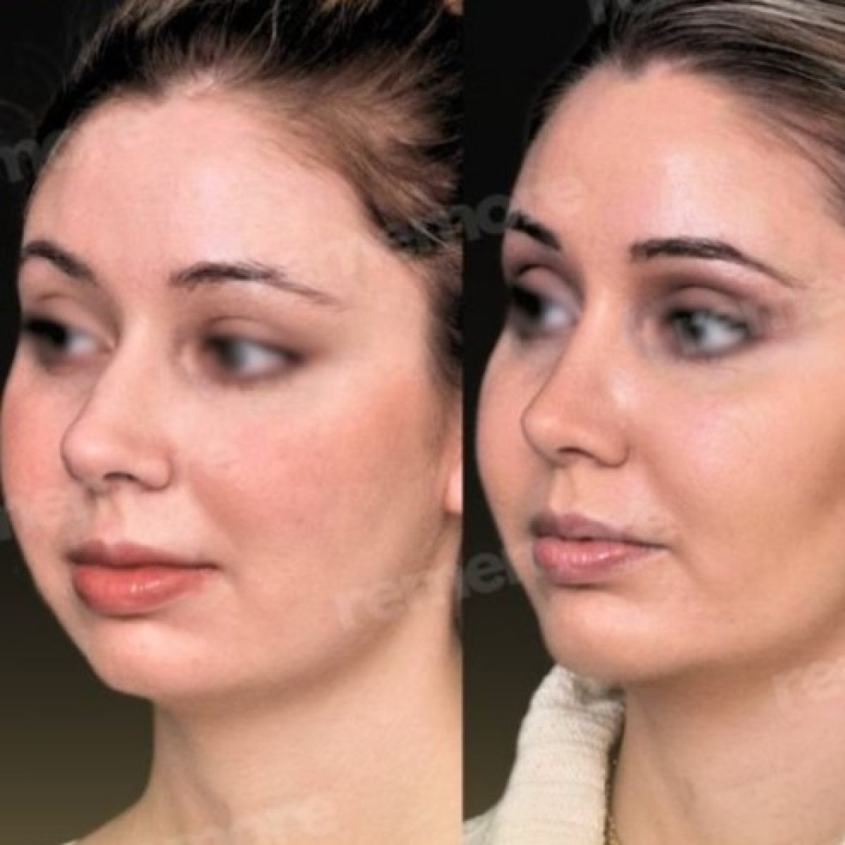 Before and after buccal fat extraction results at Memorial Göztepe Hospital, slimmer cheeks