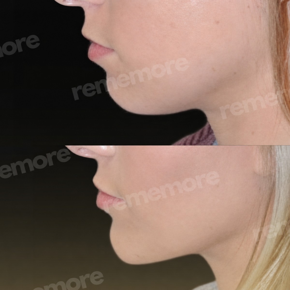 Before and after double chin liposuction results at Memorial Göztepe Hospital, improved jawline